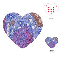 Histology Inc Histo Logistics Incorporated Human Liver Rhodanine Stain Copper Playing Cards (heart)  by Mariart